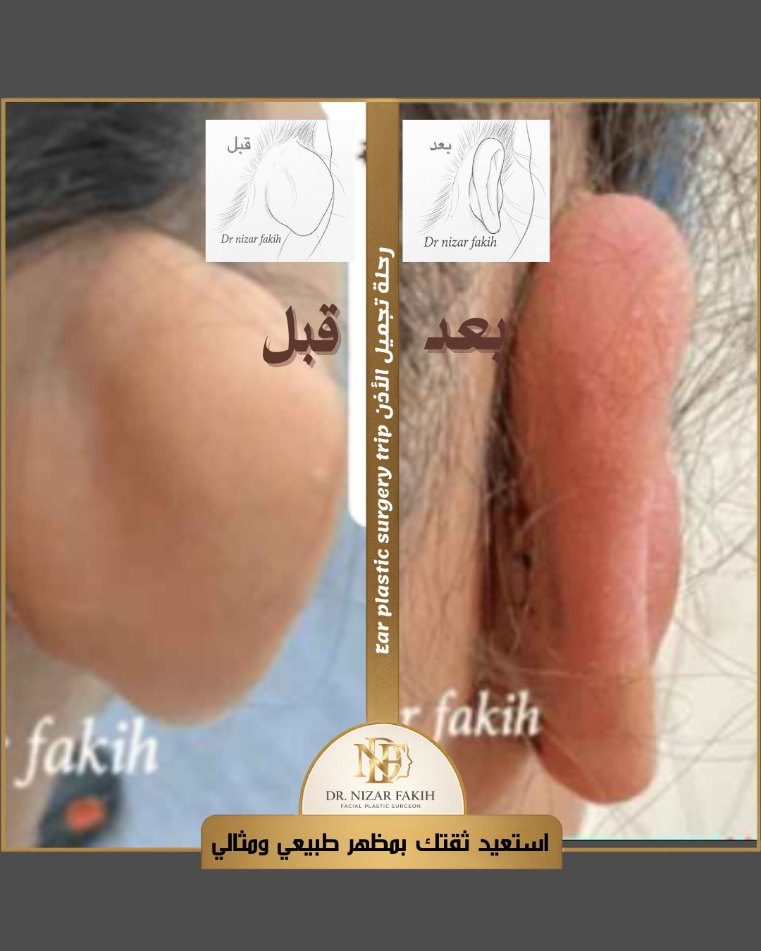 نتيجة عملية تجميل الأذن في جدة تظهر تصحيح بروز الأذن بشكل طبيعي ومتناسق