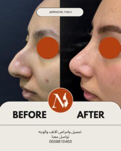 نتيجة تجميل الأنف 3