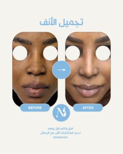 نتيجة تجميل الأنف 2