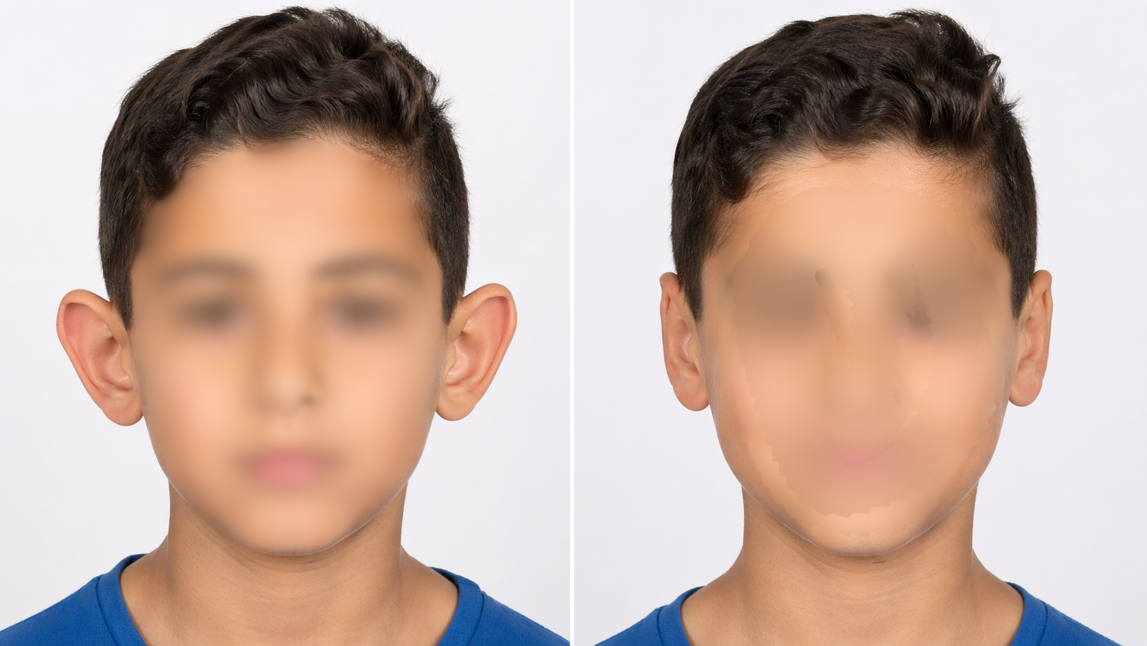 مقارنة طبية احترافية قبل وبعد عملية تجميل الأذن البارزة (Otoplasty) بتقنية نحت الغضروف في جدة مع الدكتور نزار فقيه، تُظهر الأذن قبل العملية بارزة بزاوية تتجاوز 45 درجة وبعدها في وضع طبيعي متناسق قريب من الرأس دون أي ندبات ظاهرة