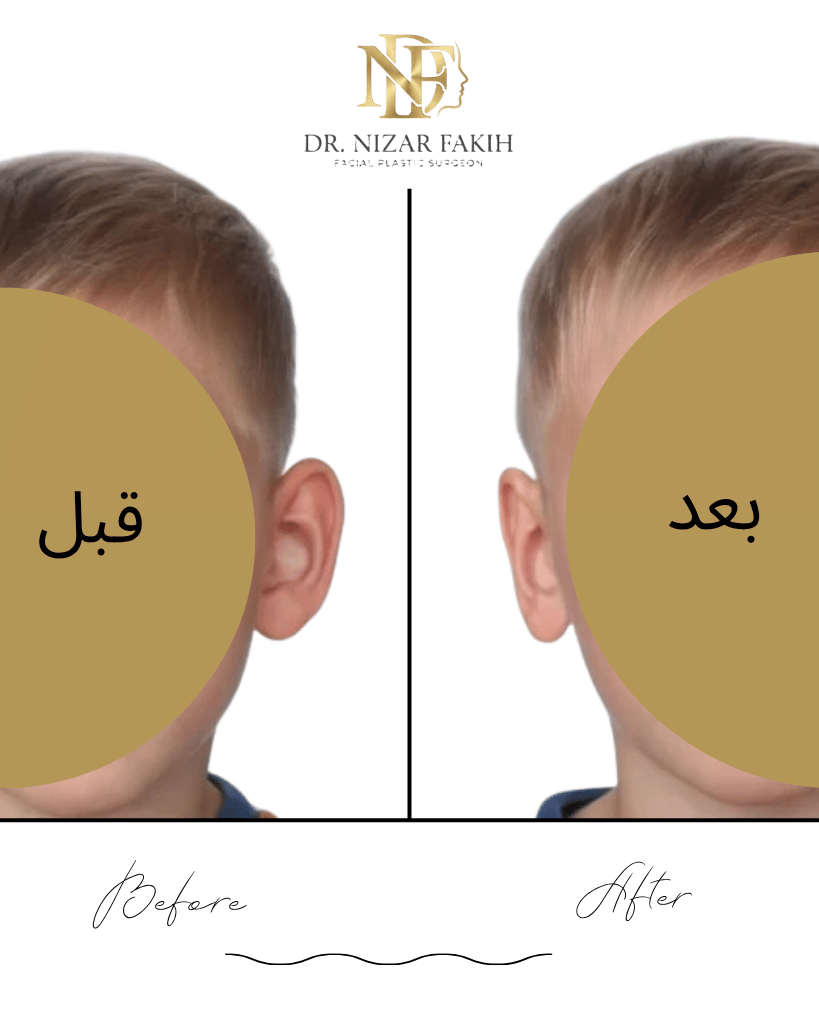 نتيجة عملية تجميل الأذن الخفاشية — جدة