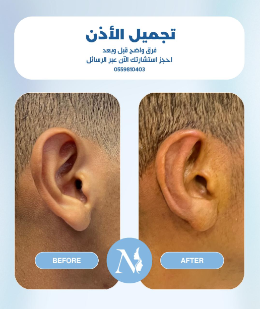 تجميل أذن جديد