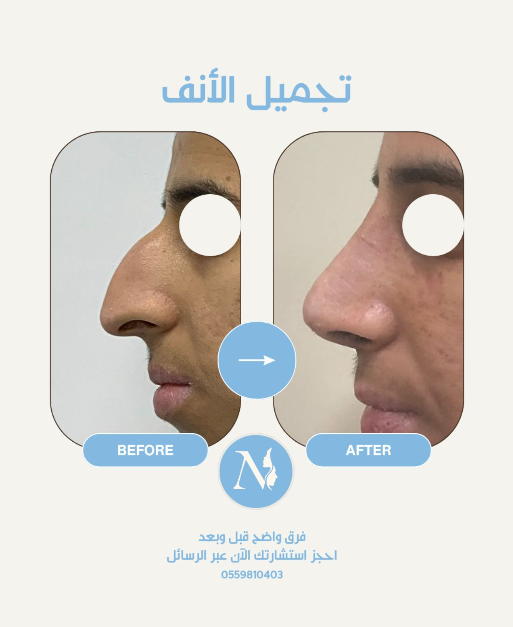 تجميل أنف جديد