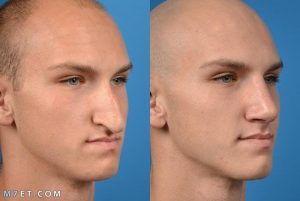 عمليات تجميل الأنف في السعودية